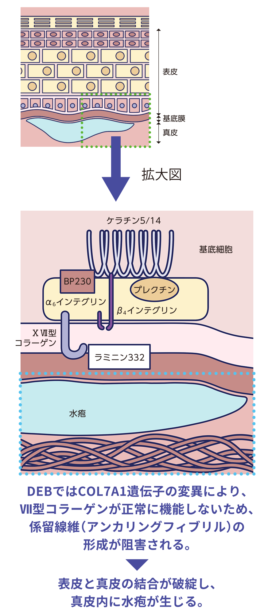 DEBの皮膚構造図解 DEBではCOL7A1遺伝子の変異により、Ⅶ型コラーゲンが正常に機能しないため、係留線維（アンカリングフィブリル）の形成が阻害される。表皮と真皮の結合が破綻し、真皮内に水疱が生じる。